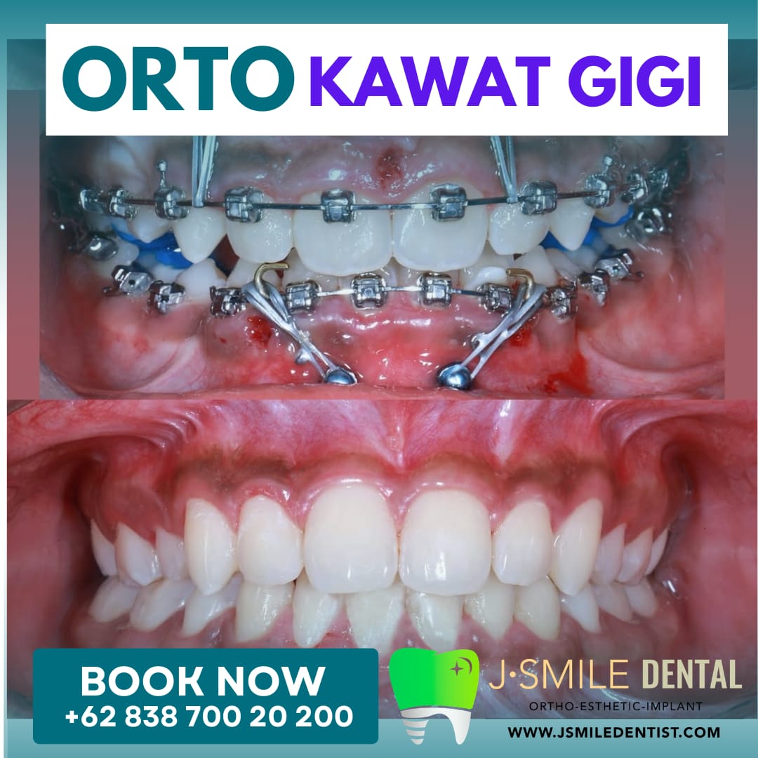 Perbandingan sebelum dan sesudah perawatan kawat gigi (behel) — kasus 1